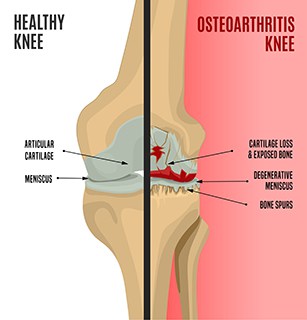 Osteoarthritis Lake St Charles, MO