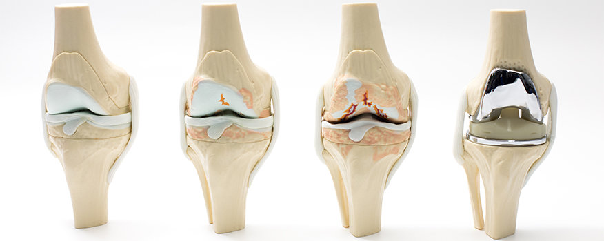PRP Therapy for Joint Pain a Non-Surgical Solution for Osteoarthritis and Injuries Washington, MO