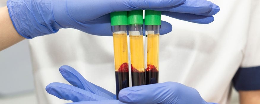 Treating Thinning Hair With PRP Injections Washington, Missouri